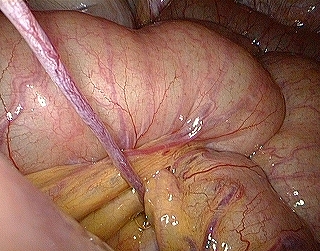 腸閉塞手術1