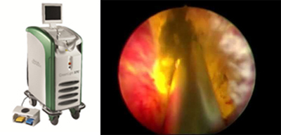 532nmレーザー光選択的前立腺蒸散術