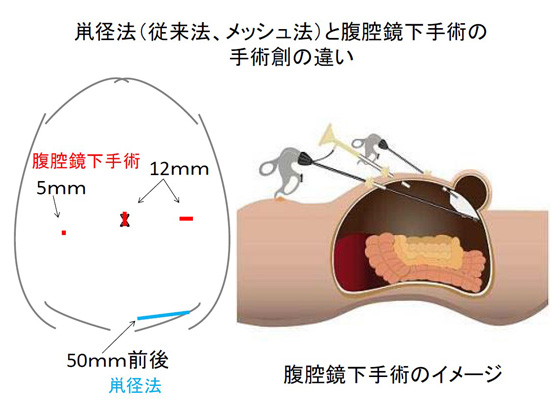 鼡径、大腿ヘルニア