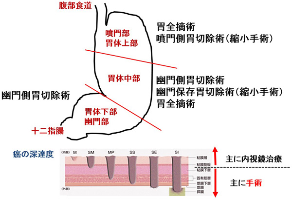 胃癌手術の概要