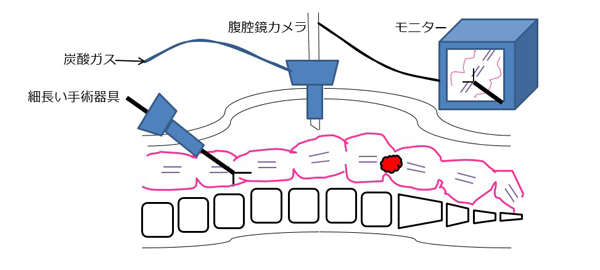 大腸癌の治療方針