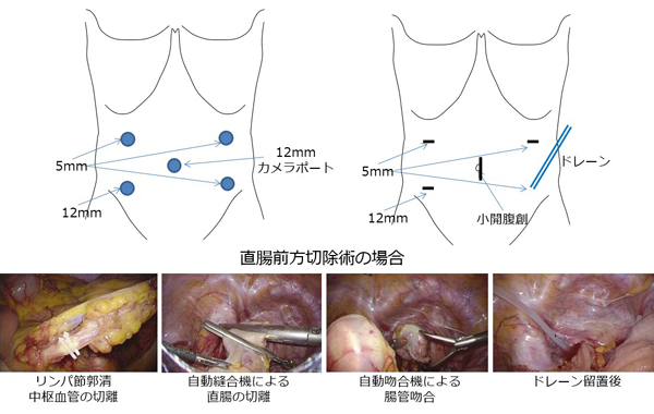 大腸癌の治療方針