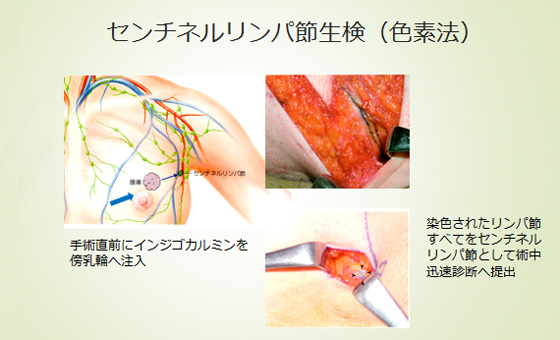 大腸癌の治療方針