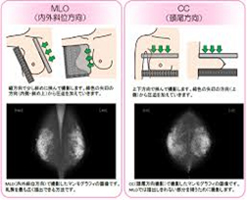 マンモグラフィ撮影方法1