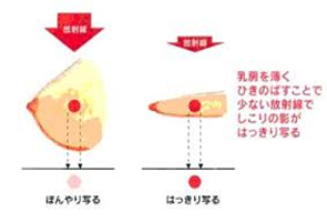 マンモグラフィ撮影方法2