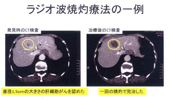 ラジオ波焼灼療法の一例