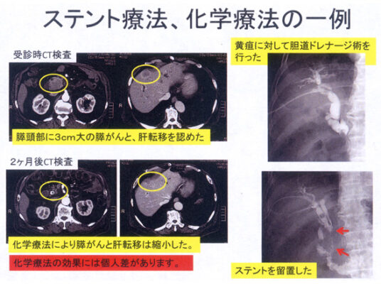 ステント療法、化学療法の一例