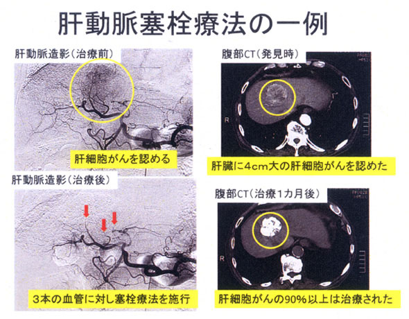 冠動脈塞栓療法の一例