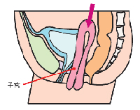 図2 子宮脱