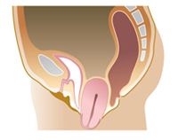 図3 膀胱脱と子宮脱の合併