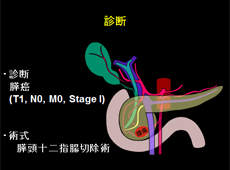 膵頭十二指腸切除術