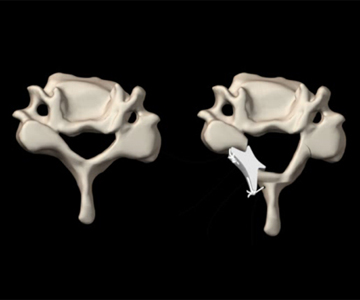 人工骨を利用し、脊柱管を拡大します 