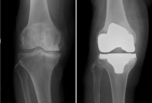 人工膝関節置換術2