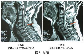 手術後MRI画像