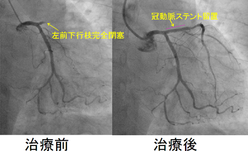 急性冠症候群（急性心筋梗塞・不安定狭心症）