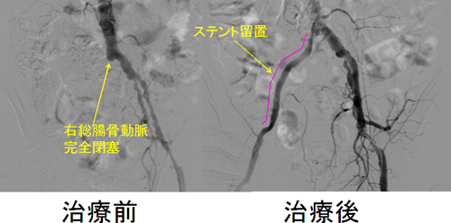 閉塞性動脈硬化症