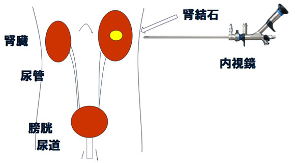 経皮的腎結石砕石術