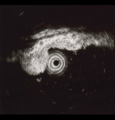 超音波内視鏡による深達度診断2