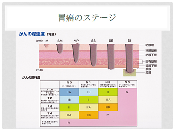 胃癌のステージ