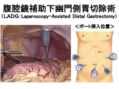 腹腔鏡下胃切除の手術イメージ