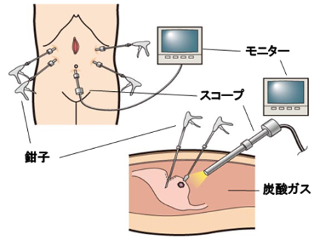 腹腔鏡を用いた手術のイメージ