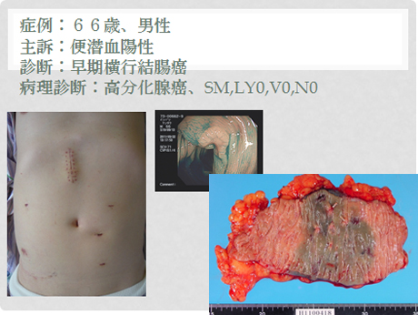 検診の便潜血で発見された早期の結腸癌症例2